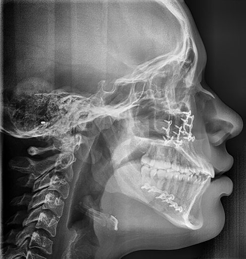 jaw surgery orthognathic surgery surgical orthodontics hinsdale clarendon hills westmont oak brook willowbrook western springs la grange