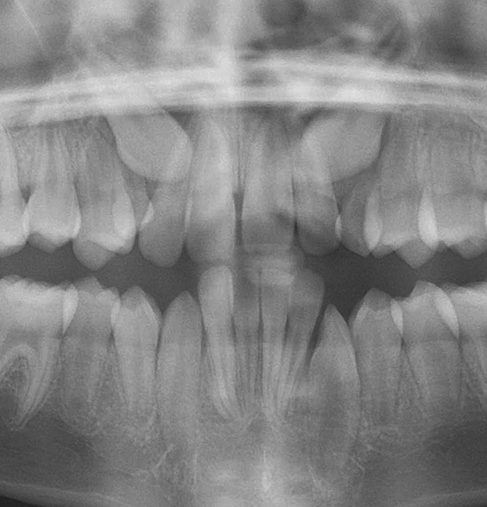 jaw surgery orthognathic surgery surgical orthodontics hinsdale clarendon hills westmont oak brook willowbrook western springs la grange downers grove