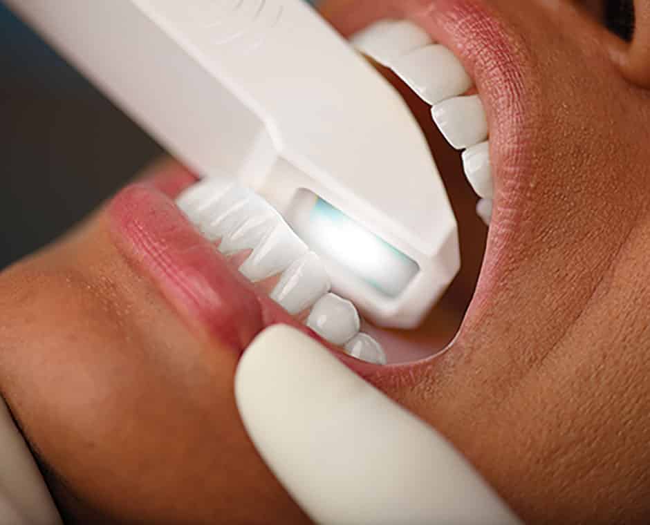 itero element scanner hinsdale orthodontist clarendon hills orthodontist