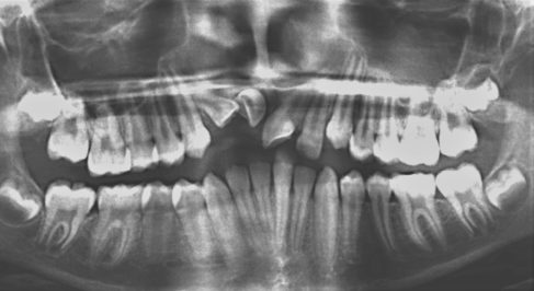panoramic xray showing impacted incisors in child needing braces in clarendon hills
