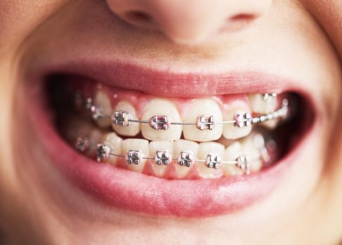 Photo of a patient needing braces pain relief and showing off their brackets.