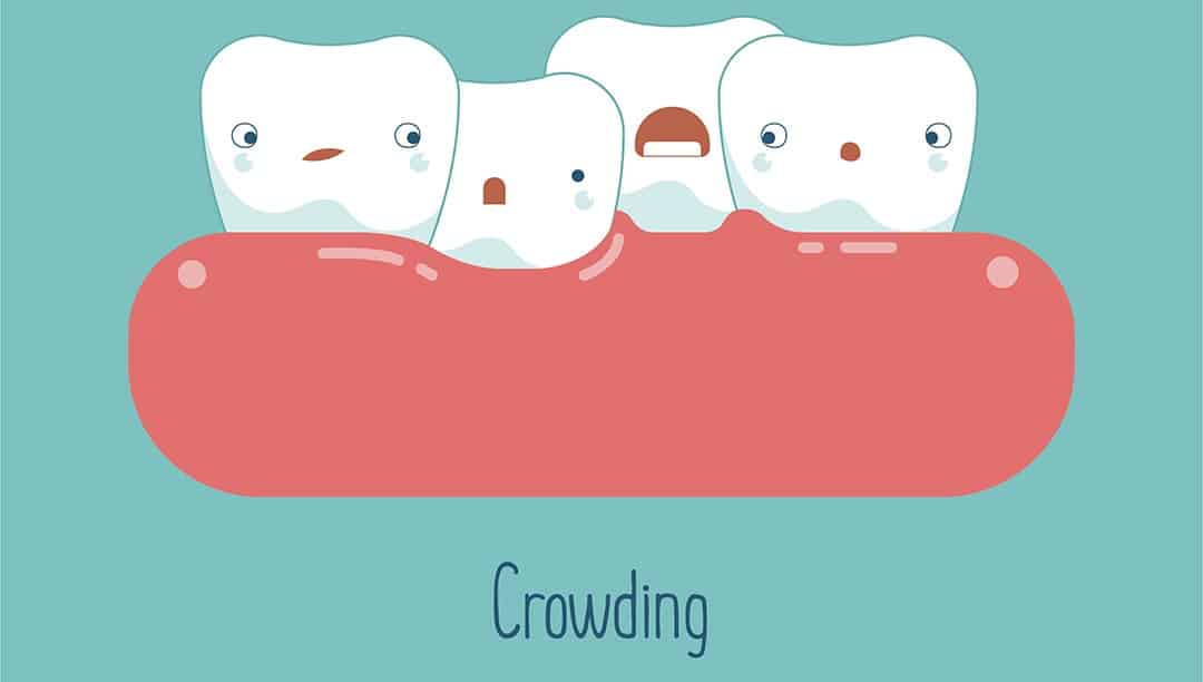 dental-crowding-orthodontics-clarendon-hills-hinsdale. teeth shifting