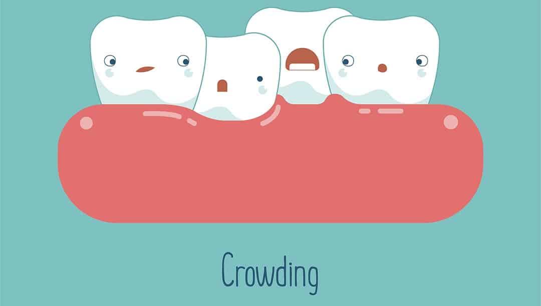 Teeth Shifting: Why This Occurs and How to Prevent