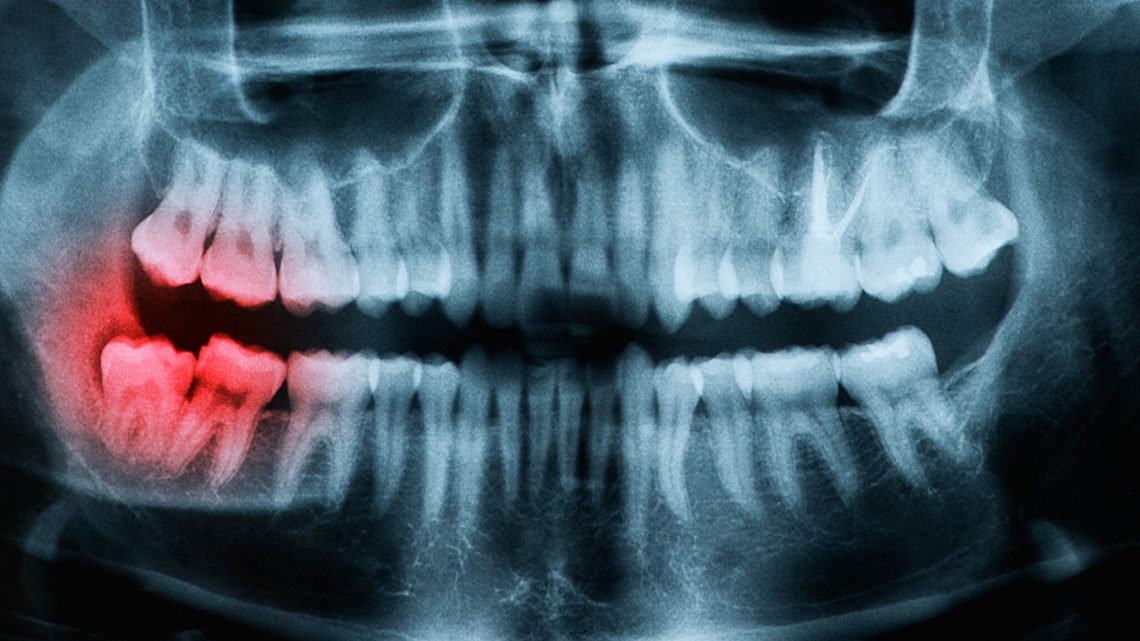 age of teeth and mouth with wisdom teeth