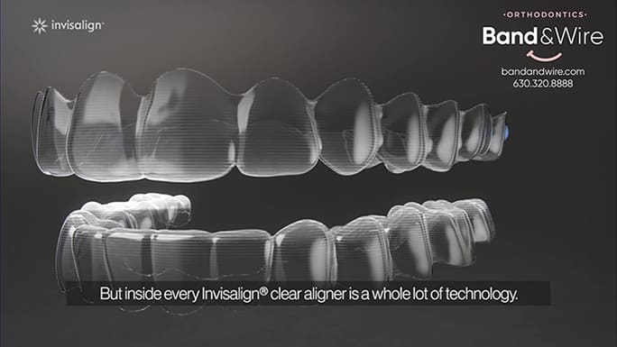 Invisalign And Braces Band And Wire Orthodontics Free Consultations