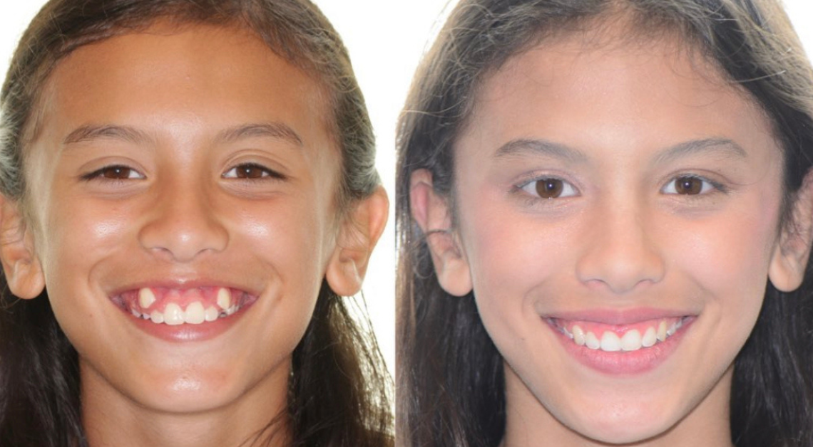 Invisalign before-and-after photos.
